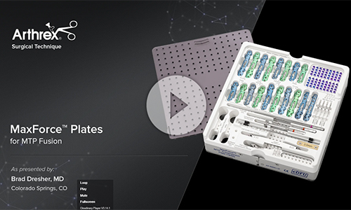 Arthrex MaxForce MTP Fusion Video Thumbnail